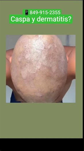 Caspa y dermatitis? aquí está la solución. bruni natural hair. 849-915-2355