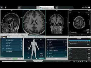 “Brain Tumor Detection with MR Spectroscopy 🧠🎯 | Real Case Review”