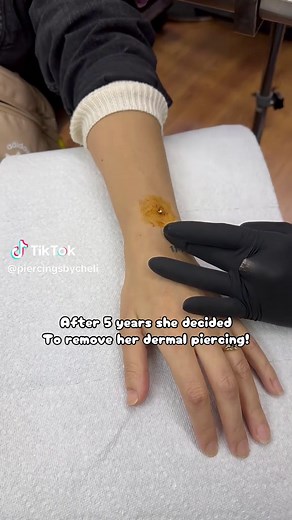 Have you ever seen how to remove a dermal piercing? TW: if you afraid to needles avoid the video!⚠️#piercingsoftiktok #viral #dermalpiercing #explor #fyp @Imperio Ink