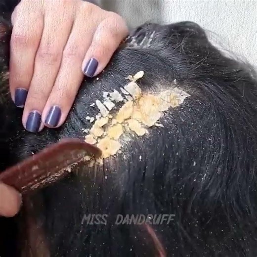 Dandruff Scratching