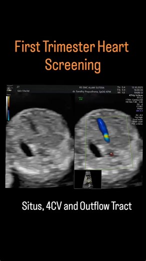 A 2020 meta-analysis found a pooled sensitivity of 75% and a pooled specificity of 99% for detecting Major CHD in the first trimester. | Cardiophilia