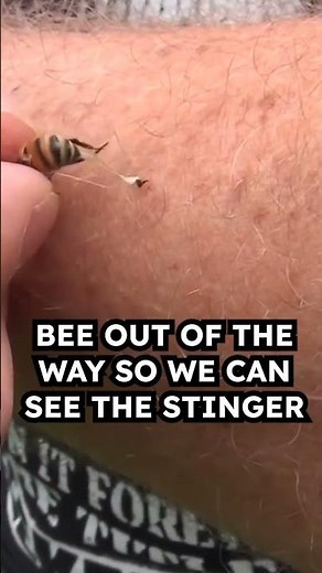🐝 First Aid Tips – Removing a Bee Stinger #beesting #firstaid #australiawidefirstaid