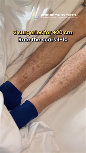 Prof. Dr. Yuksel Yurttas | Limb Lengthening Surgery on Instagram: "☝️ 3 surgeries. 20 cm taller. This is what the scars actually look like. Gaining 20 cm (8 inches) involves three separate procedures (when done in a safe way). When lengthening the bone this much, the way the skin and soft tissue are handled is just as important as the surgery itself. These results come directly from the surgical experience and tissue management of Prof. Dr. Yüksel Yurttaş and his team during each operation. We’l