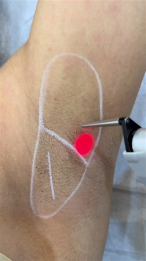 Understanding Laser Hair Removal Treatments