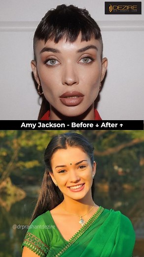 Amy Jackson's Stunning Transformation – Surgery or Natural? 🤔 Disclaimer : This content is provided for educational and informational purposes only and does not intend to promote, criticize, or speculate about any medical procedures, individuals, or the world of celebrities. The information shared is general and should not be considered factual proof of any surgical procedures. Discussions about celebrity transformations are based on observations and speculation, not confirmed medical facts. Fo