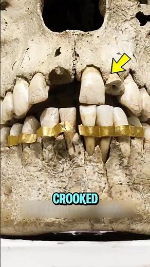 What REALLY Happens to Your Teeth with Braces 😬🦷