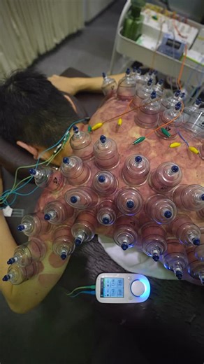 カッピング/鍼灸/八王子/つかさ鍼灸整体院🪡sasaki keita on Instagram: "【大学教授の多忙による全身不調】 職業:大学教授 主訴:背中全体の疲労、全身の不調 論文執筆・授業準備・学生指導など、長時間のデスクワークと精神的負荷により、交感神経優位の状態が慢性化。背部筋群の過緊張と全身の疲労が蓄積していました。 評価: ・背中全体の強い張りと疲労感 ・交感神経優位（常に緊張状態） ・関節可動域の低下 ・血液循環の不良 施術: 東洋医学×西洋医学のハイブリッドアプローチ ①鍼治療 華佗夾脊穴を中心に配穴 自律神経調整（交感神経優位→副交感神経優位へ） 深部組織へ直接アプローチ ②カッピング療法 背部全体に配置 筋膜の張力調整と局所血流20-40%増加 組織の柔軟性改善 結果: ✅ 関節可動域の改善 ✅ 血液循環の向上 ✅ 疲労回復の促進 ✅ 全身の緊張緩和 理論: 🫀自律神経調整 🧬筋膜メカノトランスダクション ⚡圧電効果 知的労働の疲労は身体にも蓄積します 定期的なコンディショニングが重要です 3/19(木)セミナー