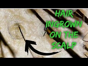 Hair Ingrown on the scalp|shortvideo|