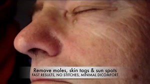 1.5K reactions · 384 shares | Removal of Moles, skin tags, age spots,...