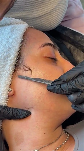 In this relaxing skincare session, professional dermaplaning helps remove.#skincare