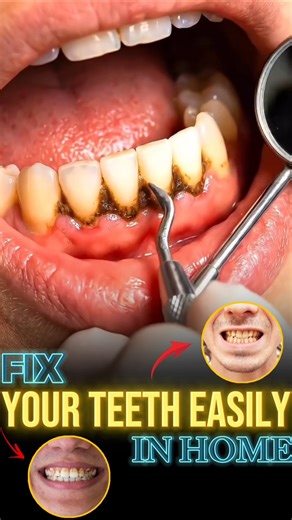 Fix Your Teeth Problems