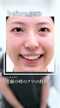 Transform Your Smile: Under-Eye Fat Removal + Fat Grafting ┃ Dark Circle Correction
