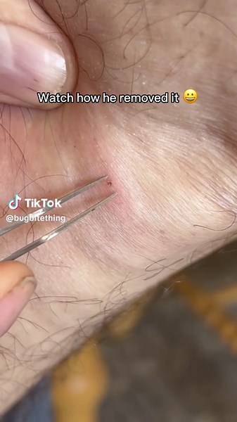 Larval Stage Tick Removal - Tick Man Dan's Discovery