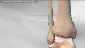 Syndesmosis TightRope® XP Implant System