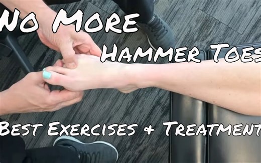 【MotionRelease】最佳的锤状趾(hammer toe)康复练习和非手术治疗方法