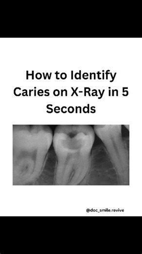 Dr priyanka | Caries reading on X-rays is confusing for MOST dental students. This 5-second guide makes it easy — save it for clinics!” #dentistry... | Instagram