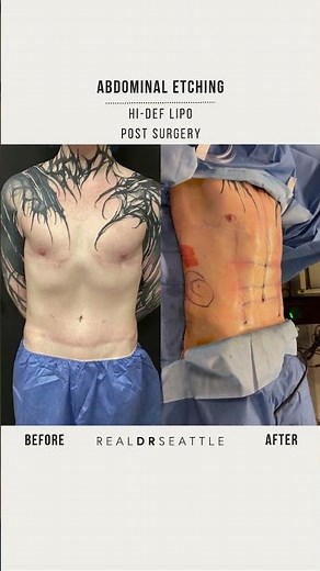 Abdominal Etching + Hi-Def Lipo ✨