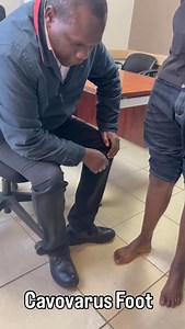 Cavovarus Foot 👣 This is a foot deformity where the arch is too high and the heel turns inward, often leading to pain, ankle instability, calluses, and repeated sprains. Surgical correction (when symptoms persist): 🔧 Treatment is tailored to the deformity and may include: • Soft tissue releases or tendon transfers • Heel realignment osteotomy • Midfoot or forefoot osteotomies • Occasionally joint fusion for severe cases The goal is a balanced, stable, pain-free foot. #CavovarusFoot #FootDeform