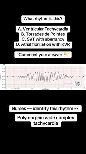 What is Torsades de Pointes? How do you treat torsades? When do you shock vs give magnesium? Let’s make this simple. This rhythm is Torsades de Pointes — a form of polymorphic ventricular tachycardia associated with prolonged QT interval. It looks like: • Rapid wide-complex tachycardia • QRS complexes twisting around the baseline • Changing amplitude beat to beat ⚠️ Why it matters: Torsades can quickly deteriorate into ventricular fibrillation. If you don’t recognize it, you lose time. ⸻ 🚨 Tors