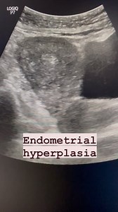 43 reactions | Endometrial hyperplasia #endometrialhyperplasia #endometrium #hyperplasia #gynaecology #uterusultrasound #pelvicinflammatorydisease #pelvicultrasound #endometrialpathology | Ultrasound made easy | Facebook