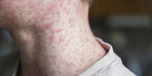 Measles case reported in Anchorage, health officials say