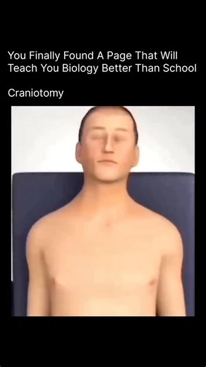 BIOLOGY | MEDICAL | HEALTH on Instagram: "Craniotomy is a life-saving brain surgery where a neurosurgeon temporarily removes a small part of the skull to access the brain. This opening allows doctors to remove tumors, stop bleeding, repair aneurysms, relieve pressure, or treat brain injuries. After the procedure, the bone flap is carefully placed back and secured, allowing the skull to heal naturally. Thanks to advanced imaging, precision tools, and modern anesthesia, craniotomy today is safer a