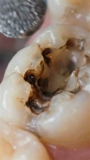 Small Black Spot in Tooth 😳 | Cavity Cleaning & Removal #cavityremoval #dentalclinic #dental