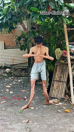 DR.SHYAM PANDIT | saber-blade tibia or "saber shin" is a deformity of the tibia, the large bone in the lower leg that causes it to bow forward resembling the... | Instagram