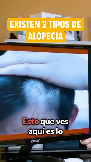 147K views · 2.7K reactions | La caída del cabello tiene varias causas, pero puedes comenzar a trabajarlas de forma natural con las propiedades del café. #alopecia #caidadelcabello #cafe #ayudasnaturales | MetabolismoTV | Facebook