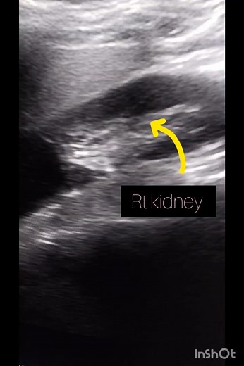 Ultrasound showing renal cortical cyst #radiology #ultrasound #doctorstrange #mbbs #