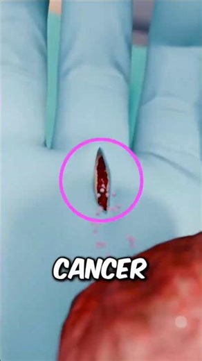These are the Shocking Cases Where Cancer Spread Through a Cut 😱