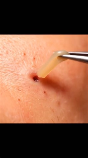 [쾌감주의] ‘쏙’ 진짜 역대급 시원한 순간 │ One Perfect POP Sebum Extraction 💥