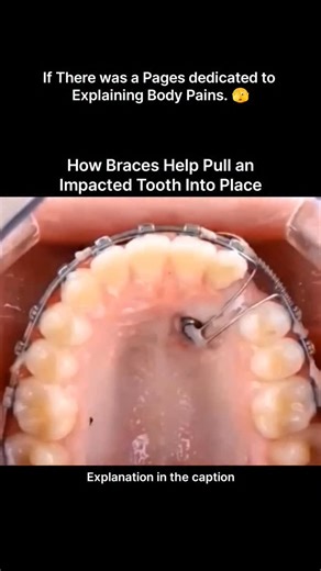 Explaining Human Pains on Instagram: "An impacted tooth occurs when a tooth fails to erupt into its normal position because it is blocked by bone, gum tissue, or neighboring teeth. Orthodontic treatment uses braces to carefully solve this problem rather than removing the tooth. First, space is created in the dental arch using braces. A small surgical exposure may be done to reveal the impacted tooth, and an attachment is bonded to it. Gentle, continuous force is then applied through orthodontic 