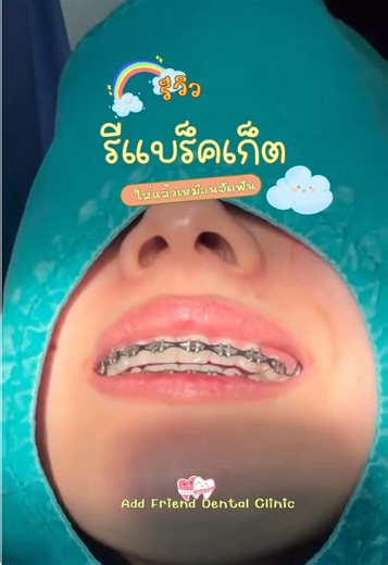 🍒โปรรีเทนเนอร์แบร็คเก็ต 🍒 🎉 4,200.-/2ชิ้น 🍓จัดฟันที่อื่นก็ทำรีที่เราได้ 🍓ถอดเครื่องมือจากที่อื่น 1,333.- ✨ฟรีพิมพ์ฟัน ✨ฟรีใส่ Glitter 🦷เติมฟันซี่ละ 300 🌈สนใจติดต่อได้ที่ Add Friend Dental Clinic ทั้ง 4 สาขา -สาขาพญาไท -สาขาราชพฤกษ์ -สาขาท่าพระ -สาขาศาลายา #คลินิกทันตกรรม #รีเทนเนอร์ #รีเทนเนอร์ไร้เหงือก #รีเทนเนอร์แบร็คเก็ต #รีเทนเนอร์เปลี่ยนยาง