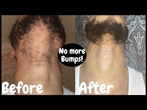 How to get Rid of Razor Bumps (ingrown hairs) Shaving 101