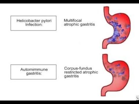 Hypertrophic Gastropathy; thickened gastric folds due to mucosal overgrowth