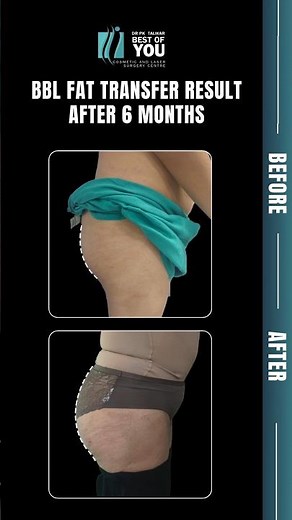 Brazilian Butt Lift (BBL) Surgery | 6 Months बाद के Results Before & After | Dr. P.K. Talwar India