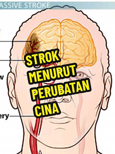 #acupuncturemalaysia #strokesurvivor #strokeawareness #akupuntur #stroke #acupuncturist