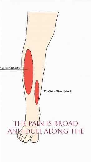 Shin splints vs Stress fracture