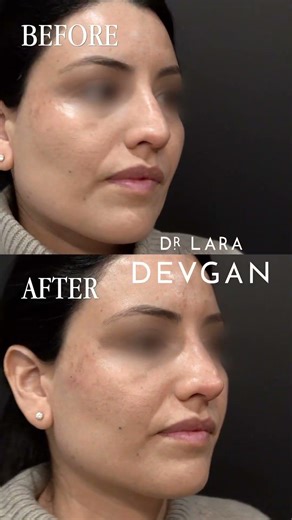 Upper Face & Gummy Smile Botox, Cheekbone Augmentation, and Nonsurgical Rhinoplasty: Before & After