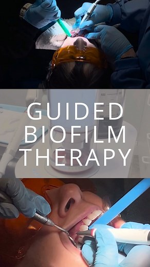 Did you know that Guided Biofilm Therapy (GBT) makes cleanings more comfortable and effective? ✅ Gentle on sensitive teeth & gums – no more harsh scraping! ✅ More effective at removing plaque & bacteria – a deeper, fresher clean. ✅ Faster cleanings – less time in the chair, more time enjoying your day! And yes… we know the purple teeth moment is a little shocking 😆, but that disclosing dye is what helps us target plaque like pros! Our patients love it, and so do we! 💜 Is your dental office usi