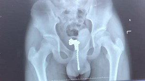 Doctor removes 68 magnetic balls from boy’s urethra in southern China