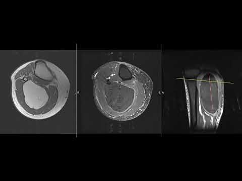 Why is my calf swelling?