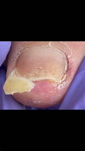 Satisfying pedicure video! #pedicure #toenails #satisfying #nails