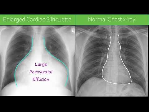 Chest x-ray - Pericardial Effusion
