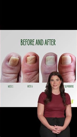 How to Fight Toenail Fungus