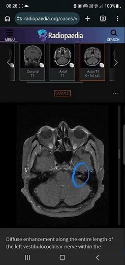 Neuroradiology - MRI Vestibular neuritis