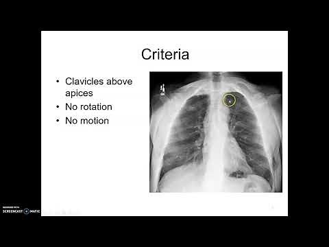 Lordotic Chest