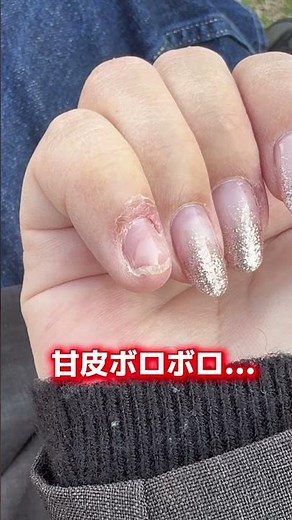 爪が取れてから1年間の変化 #深爪矯正 #深爪 #トラブル爪 #自爪育成 #爪甲剥離#nails
