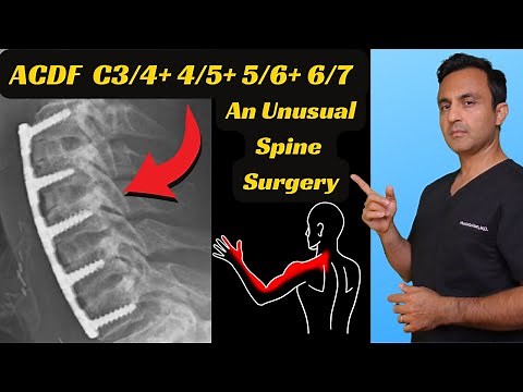 FOUR-level ACDF surgery: How it's done
